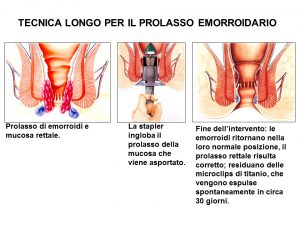 foto-emorroidi-300x225 Chirurgia Emorroidi