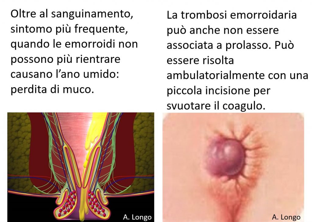La-trombosi-emorroidaria-1024x731 Prolasso delle Emorroidi