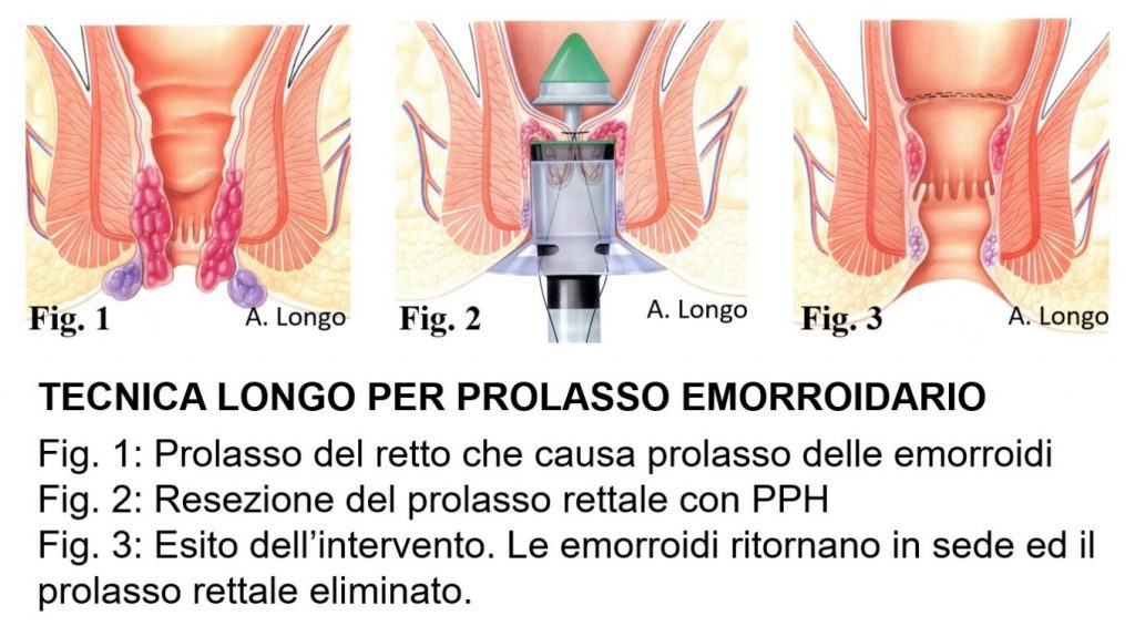 Tecnica-Longo-per-Prolasso-Emorroidario-1360x751-1-1024x565 Sindrome da ostruita defecazione