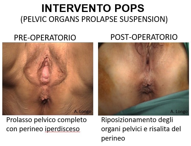 Intervento-POS Prolasso Utero e Vescica: la tecnica POPS che salva l’utero