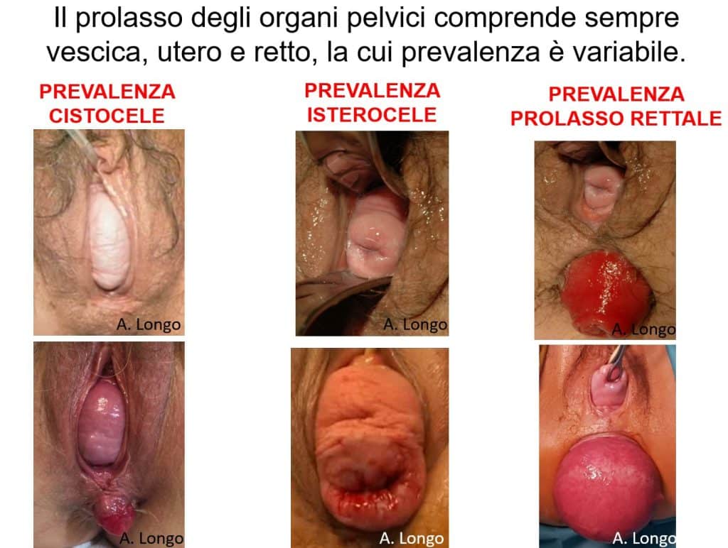 Prolasso-organi-pelvici-cistocele-isterocele-prolasso-rettale-1024x772 Prolasso Utero e Vescica: la tecnica POPS che salva l’utero
