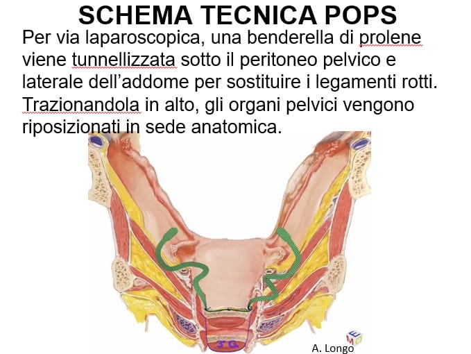 scheda-tecnica-POPS Prolasso Utero e Vescica: la tecnica POPS che salva l’utero